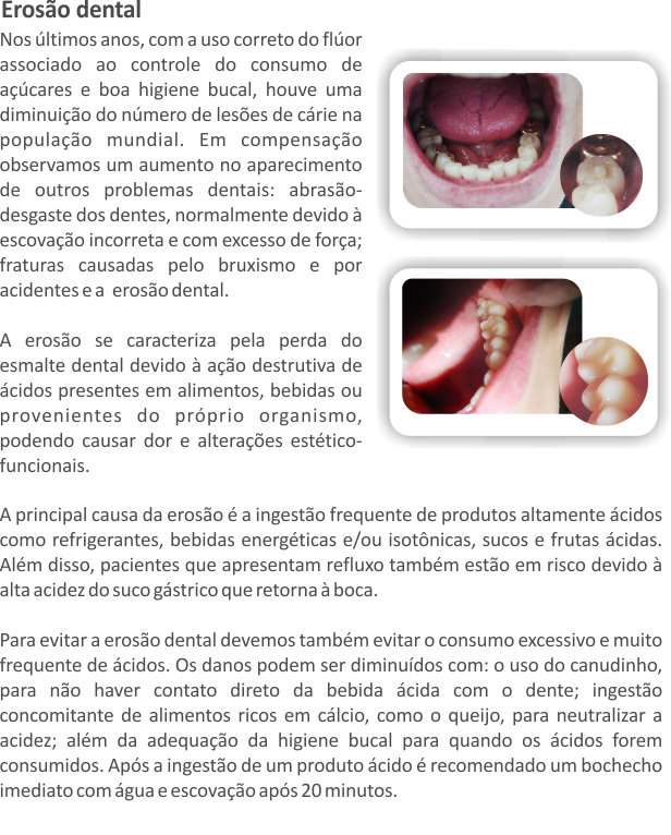 Erosão Dental em Mongaguá